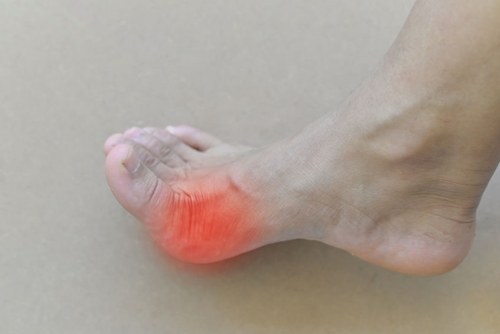 Painful and inflamed gout.